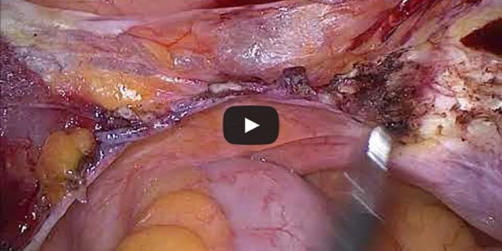 Total Laparoscopic Hysterectomy for a large uterus
